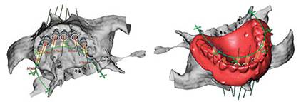 Perfect Smile nobel guide technology